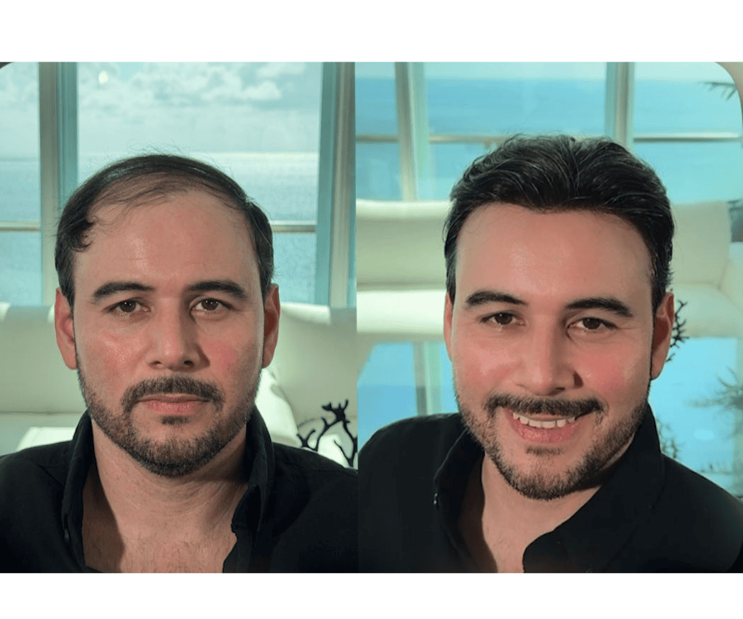 Antes y después de prótesis capilar a la medida — caso real #1 atendido por Oscar Oriente