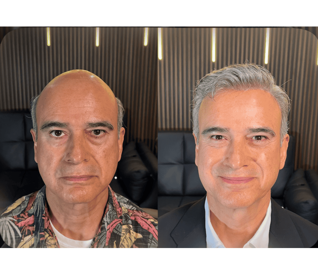 Antes y después de prótesis capilar a la medida — caso real #14 atendido por Oscar Oriente