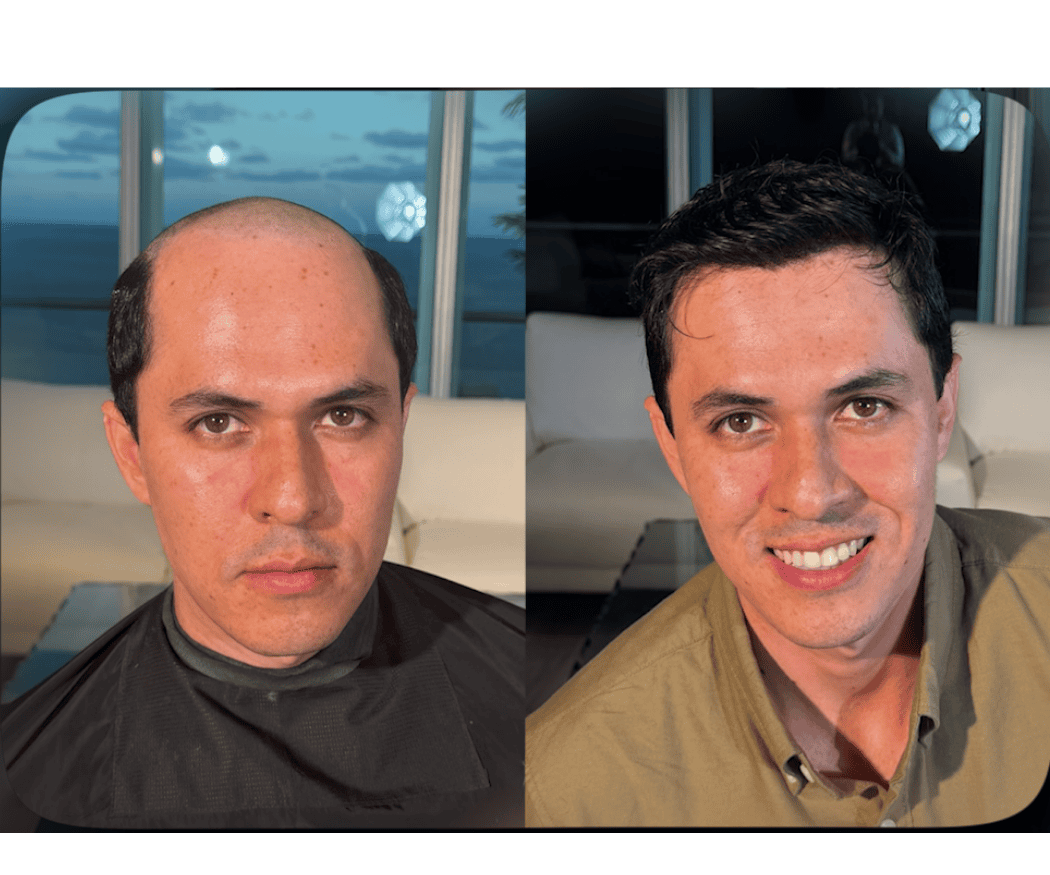 Antes y después de prótesis capilar a la medida — caso real #15 atendido por Oscar Oriente