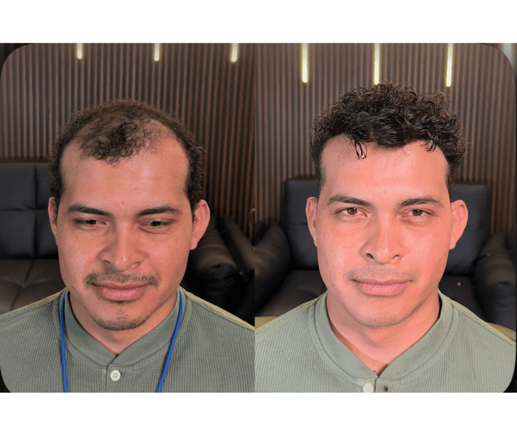 Antes y después de prótesis capilar a la medida — caso real #4 atendido por Oscar Oriente