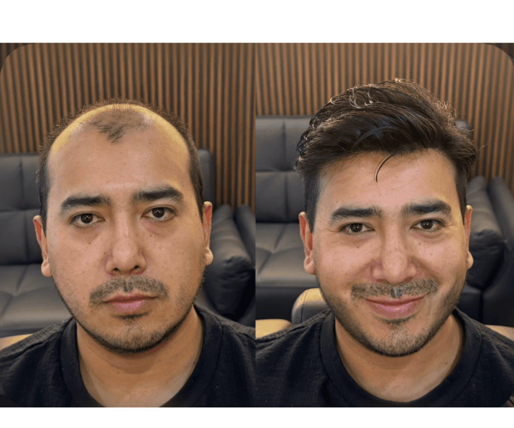 Antes y después de prótesis capilar a la medida — caso real #8 atendido por Oscar Oriente