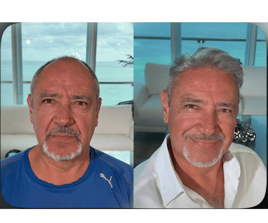Antes y después de prótesis capilar a la medida — caso real #9 atendido por Oscar Oriente